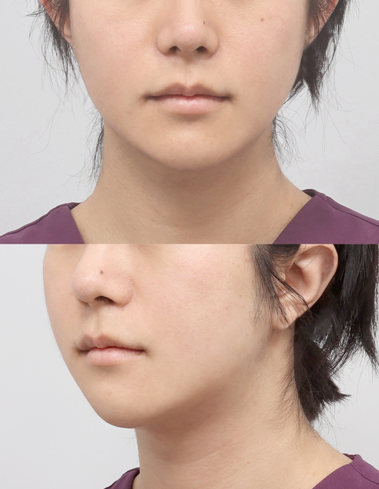 울쎄라 전후 - 에이비 피부과