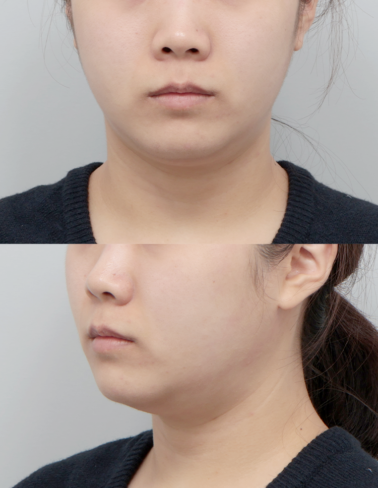 울쎄라 전후 - 에이비 피부과