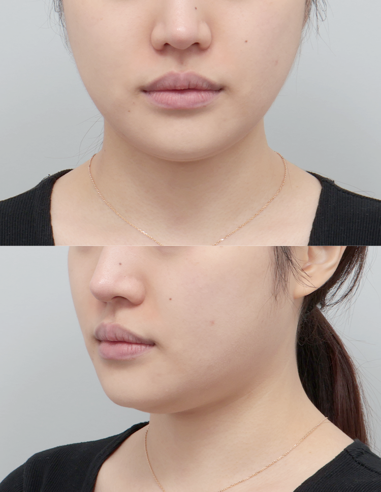 울쎄라 전후 - 에이비 피부과