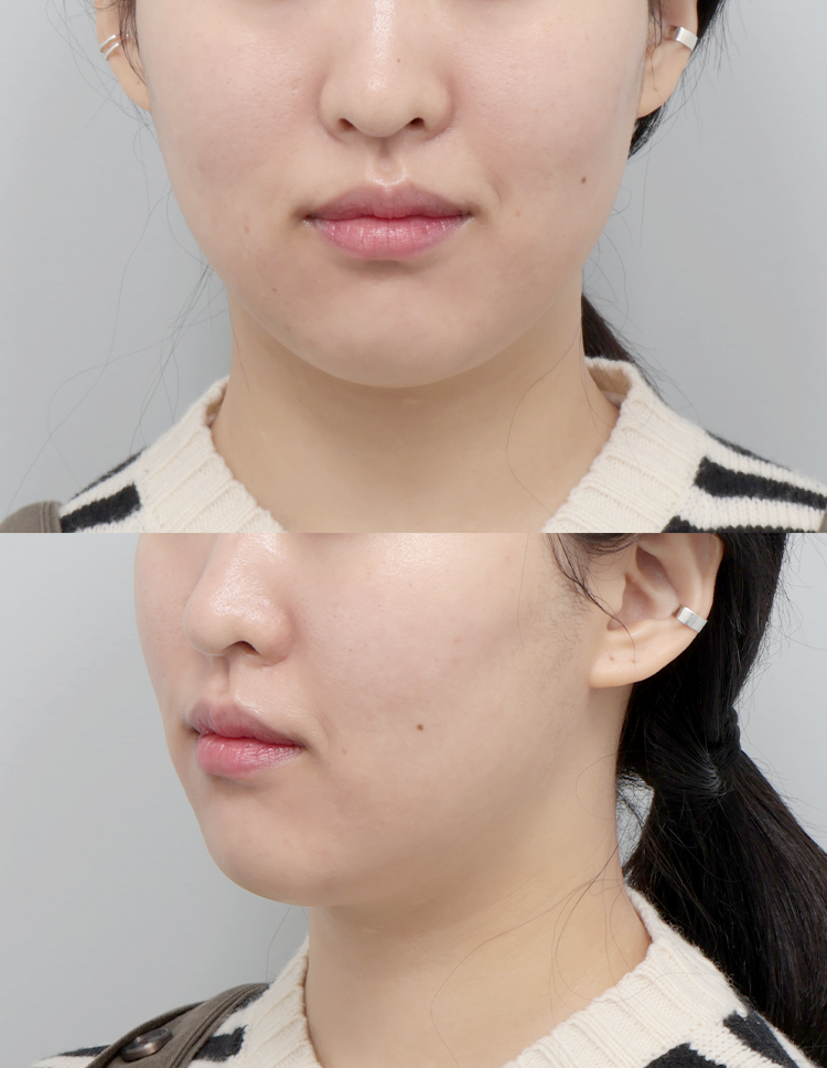 울쎄라 전후 - 에이비 피부과