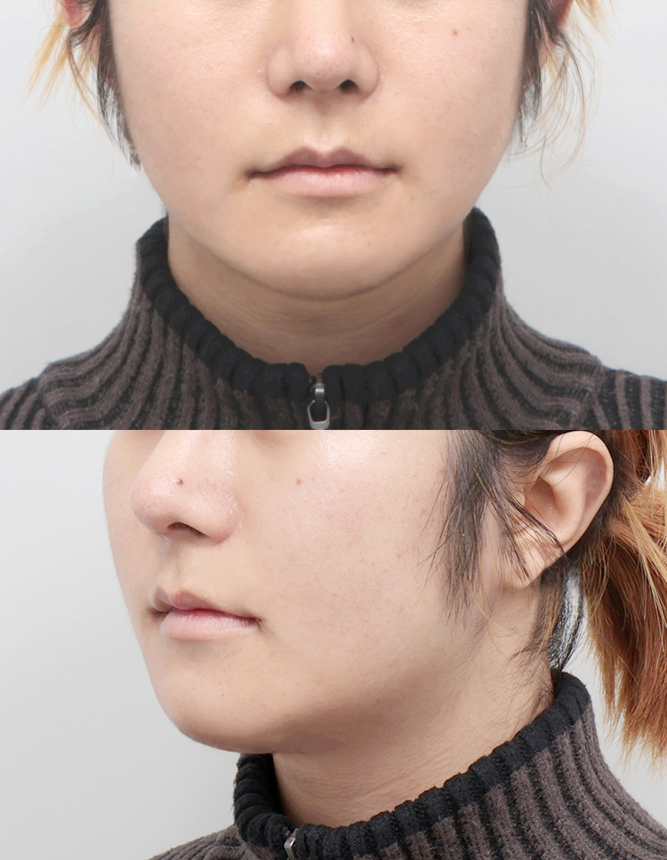 울쎄라 전후 - 에이비 피부과